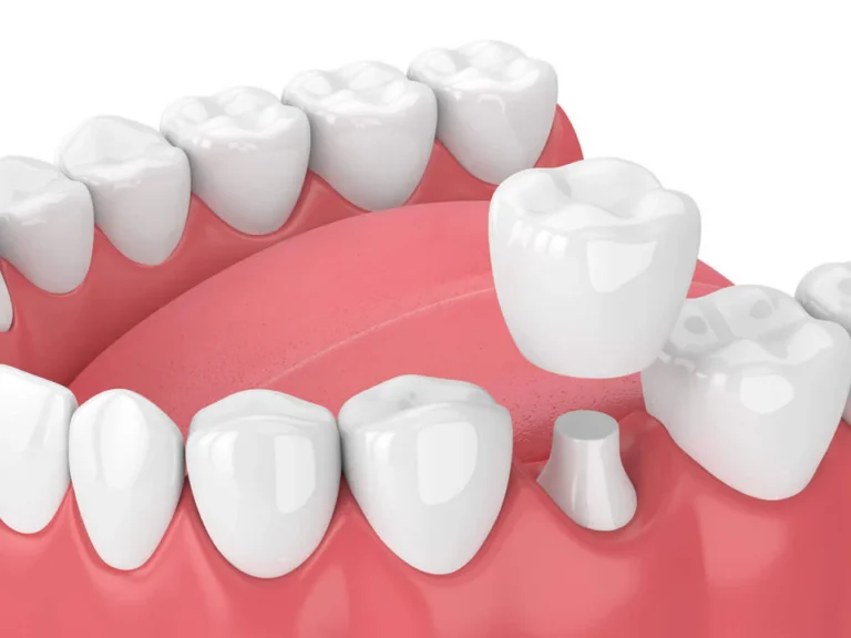 What is a crown? Summit Dental Studio blog
