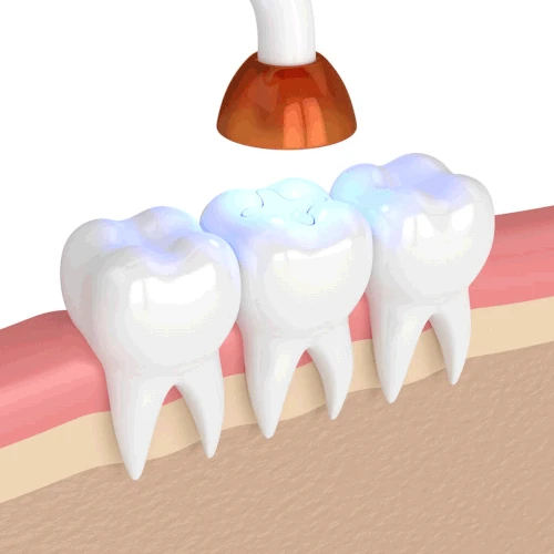 What to Do If You Lose a Filling. Summit Dental Studio blog.